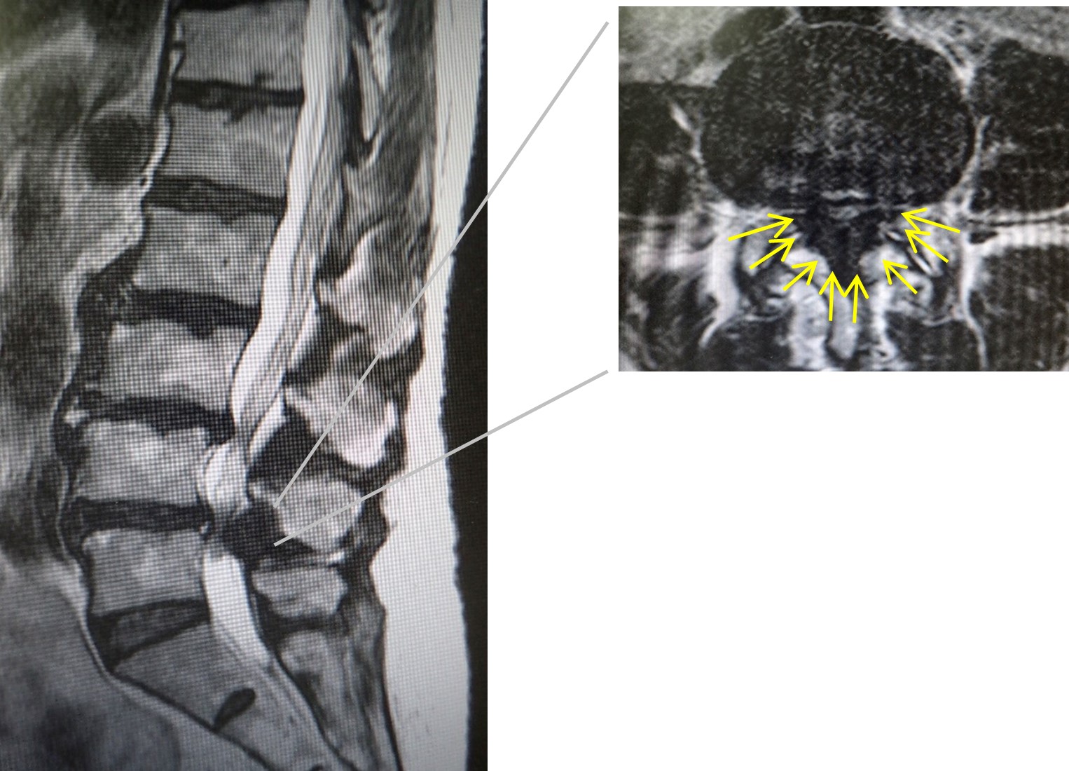腰部脊柱管狭窄症 | 整形外科医 石井賢 オフィシャルサイト